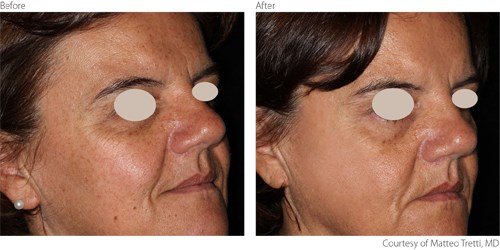 Non Ablative Skin Resurfacing Benefits Lumenis S Solution