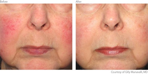 IPL Treatment Rosacea |