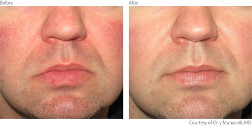 Intense pulsed light 2025 rosacea before after