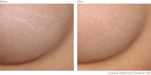 Before And After Non-Ablative Treatment