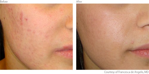 Before and after photos of acne scar laser revision