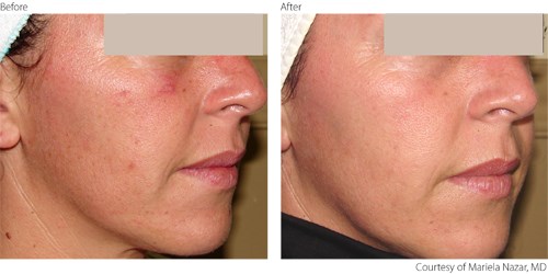 Before And After Photorejuvenation Treatment