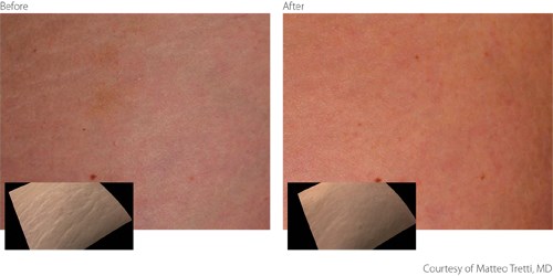 Before And After Non-Ablative Treatment