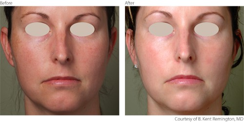 Before And After Photorejuvenation