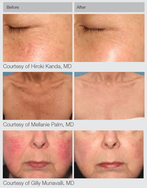 M22 IPL Laser Results Skin Rejuvenation