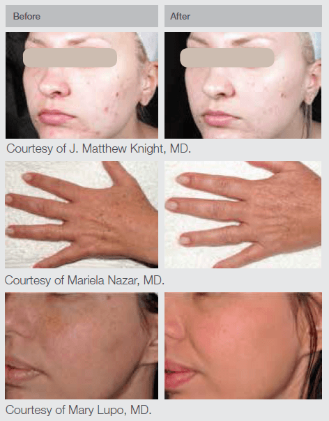 M22 IPL Laser Results Skin Rejuvenation