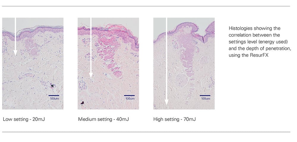 ResurFX Clinical Results