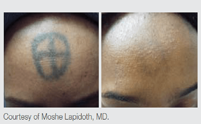 Q-Switched Nd:YAG Tattoo Removal Results
