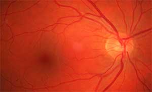 eye blood vessels with heat generated by the laser beam