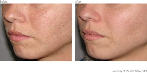 Before After Pigmentation Freckles treatment