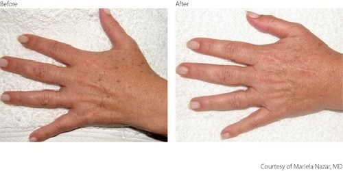 Before After Pigmentation Hands