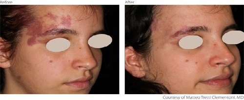 before and after Vascular Lesions treatment