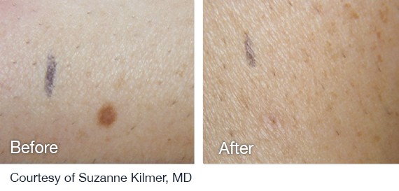 Laser Hair Removal Treatment For All