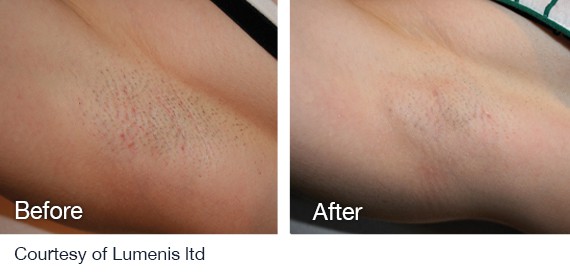 Laser Hair Removal Treatment For All Skin Types Lumenis