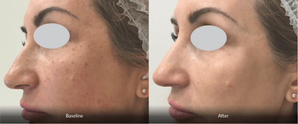 before and after Photofabulous treatment