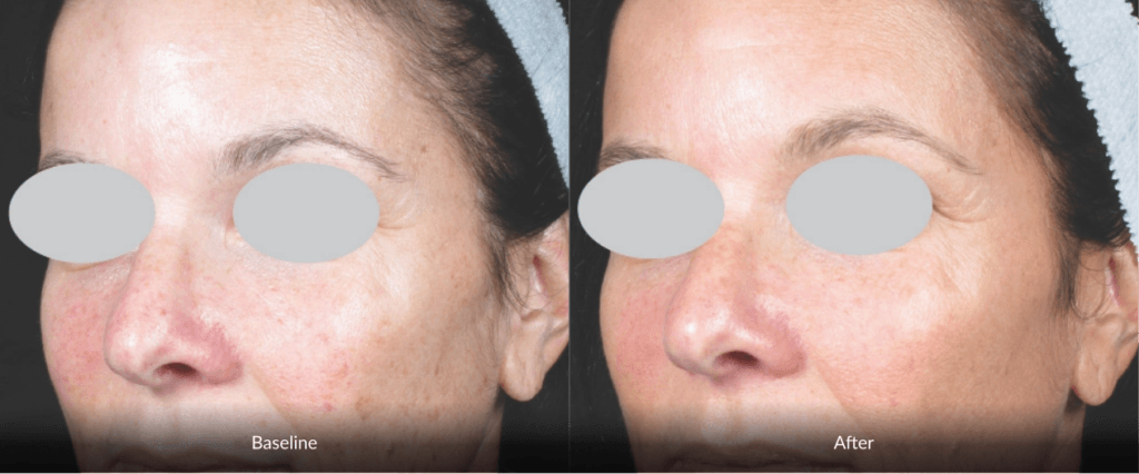 Before And After Photofabulous Treatment