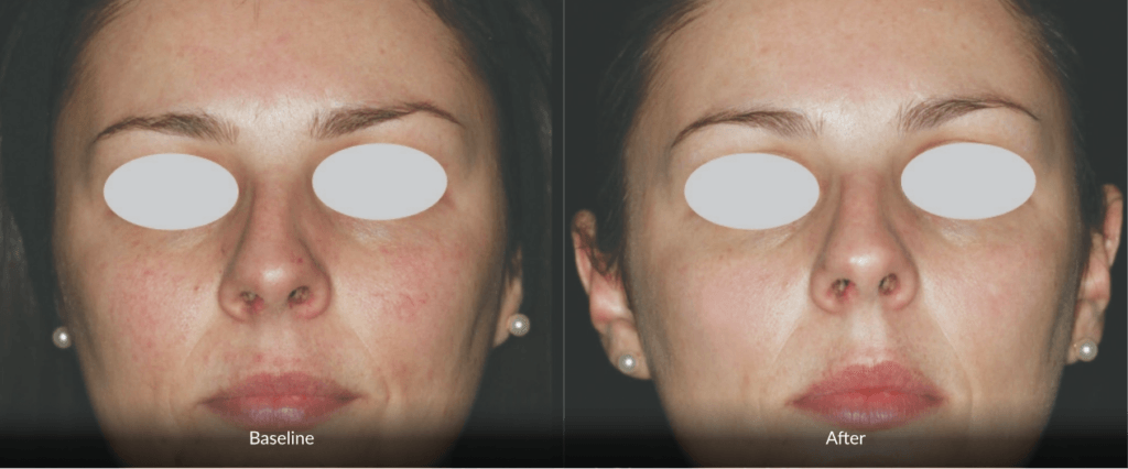 Before And After Photofabulous Treatment