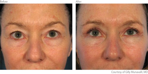 BeforeAfter1 Blepharoplasty Courtesy of Gilly Munavalli, M.D.