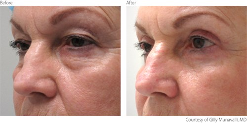 BeforeAfter2 Blepharoplasty Courtesy of Gilly Munavalli, M.D.
